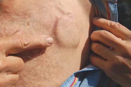 How a Pacemaker Works